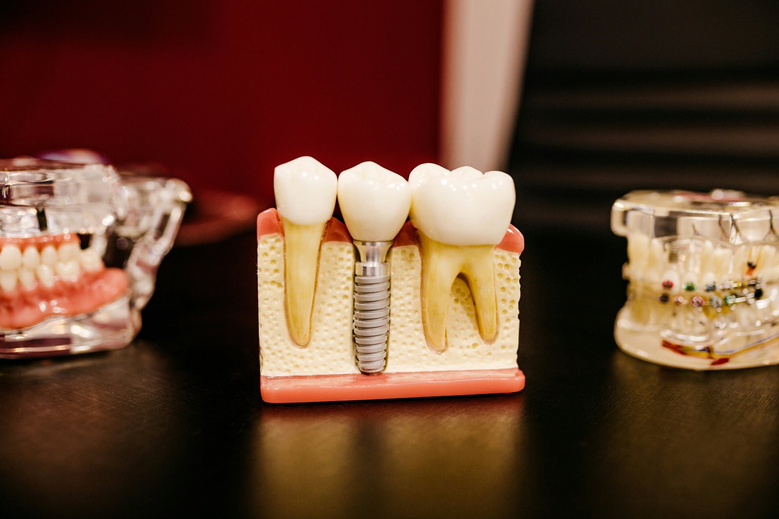 Model of a dental implant among natural teeth at Carling Dental