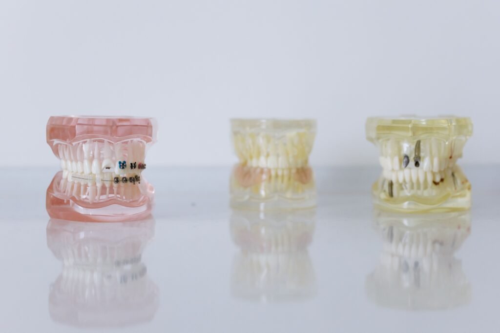 Three dental models, one fitted with orthodontic braces
